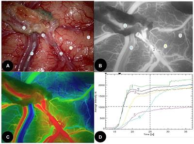 Combination of intraoperative indocyanine green video-angiography FLOW 800 and computed tomography perfusion to assess the risk of cerebral hyperperfusion syndrome in chronic internal carotid artery occlusion patients after revascularization surgery